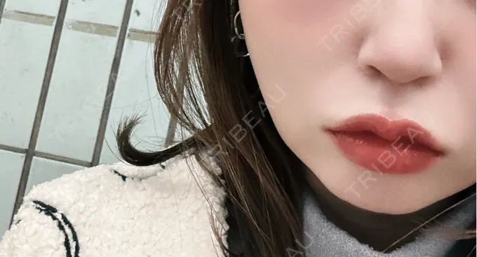 ヒアルロン酸注入（あご） / ルメッカ Code Beauty Clinic 名古屋院 BEFORE メイン用