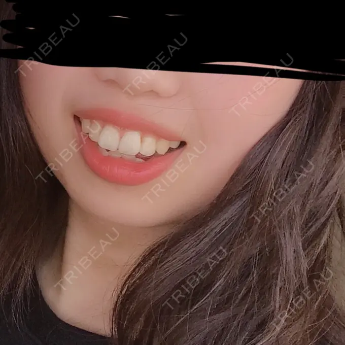 ボトックス（あご） 恵聖会クリニック 京橋院 BEFORE メイン用