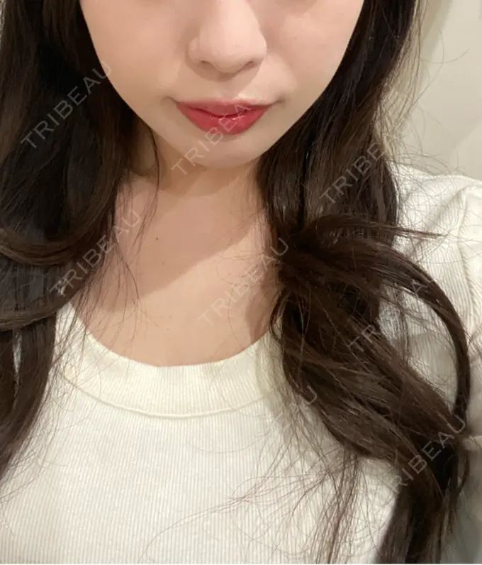 ヒアルロン酸注入（あご） ファイヤークリニック 名古屋院 BEFORE メイン用