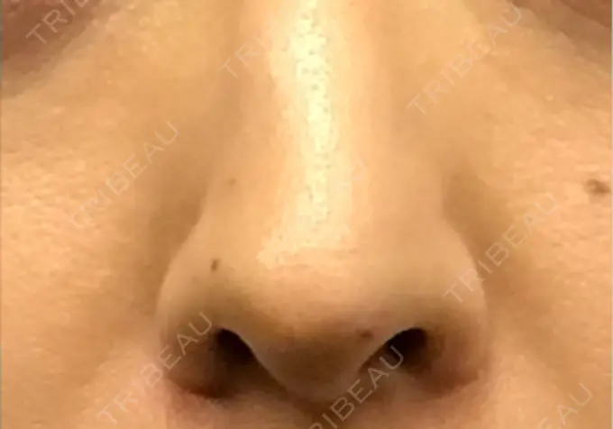 ピーリング（ニキビ・毛穴） / 美肌レーザー / シミ取りレーザー / 美白レーザー / 毛穴洗浄（ハイドラフェイシャルなど） / ピコレーザートーニング（美白・肝斑） / レーザートーニング（美白・肝斑） / レーザーフェイシャル / ピーリング（ハリ・ツヤ） LE CLINIC BEFORE メイン用