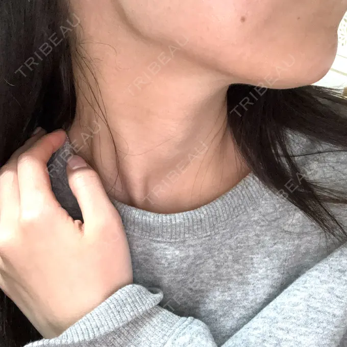 ボトックス（エラ・小顔） 共立美容外科 京都院 BEFORE メイン用