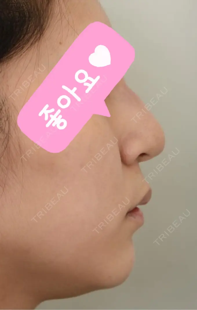 鼻尖形成（切開） / 鼻中隔延長（切開） / 軟骨移植 / 骨切幅寄せ / ワシ鼻修正・ハンプ切除 / 鼻修正 札幌ル・トロワ ビューティクリニックVogue BEFORE メイン用