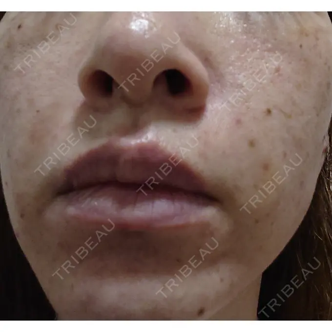 ほくろ・いぼ除去レーザー（肌） 広島プルミエクリニック BEFORE メイン用