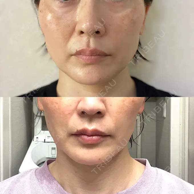 ボトックス（エラ・小顔） 東京形成美容外科 船橋院 BEFORE メイン用