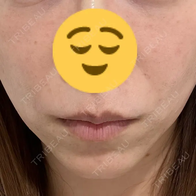 糸リフト DMTC CLINIC 日本橋院 BEFORE メイン用