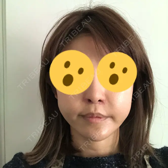 人中短縮 / 口角挙上 清潭女神美容外科 BEFORE メイン用