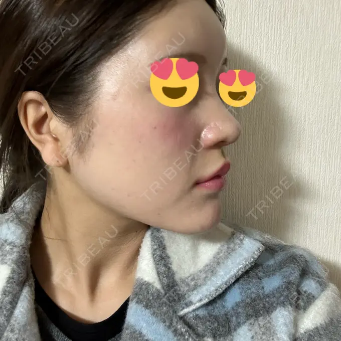 ヒアルロン酸注入（鼻翼基部） THE FIRST CLINIC 町田院 BEFORE メイン用