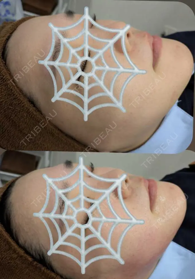 その他（肌） / エレクトロポレーション / サーマクール / RF（高周波）たるみ治療 ゆきスキンクリニック 東池袋 BEFORE メイン用