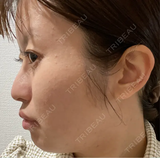 ピアス穴あけ 新宿ラクル美容外科クリニック 新宿院 BEFORE メイン用