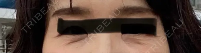 肌ヒアルロン酸注入（たるみ・シワ改善） / シワ取りボトックス / ヒアルロン酸注入（目の下） LE CLINIC BEFORE メイン用