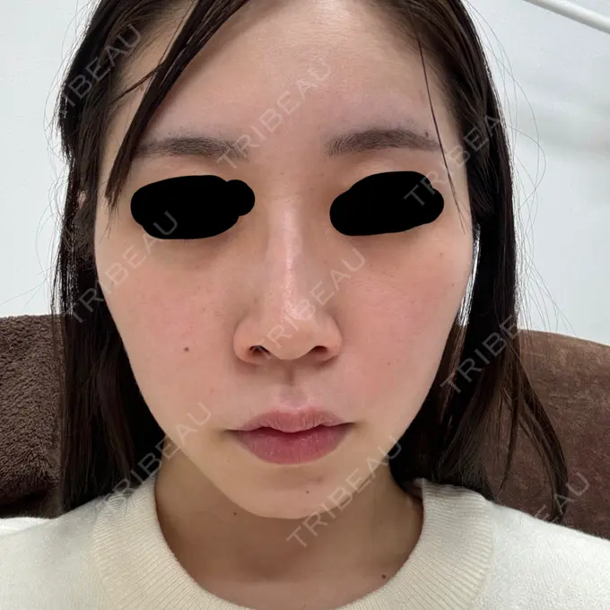 鼻翼基部形成（貴族手術） / ヒアルロン酸注入（涙袋） / ヒアルロン酸注入（あご） / ヒアルロン酸注入（頬） フィラークリニック 大阪梅田院 BEFORE メイン用