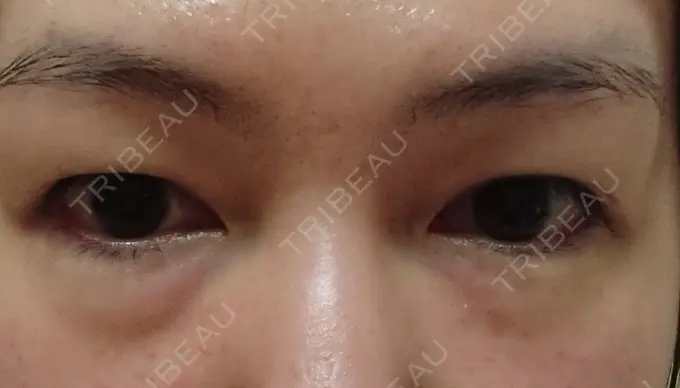 クマ治療 / 下まぶたたるみ取り / 下まぶたの脂肪取り / 脂肪注入（肌） コスメディカルクリニック シンシア 銀座院 BEFORE メイン用