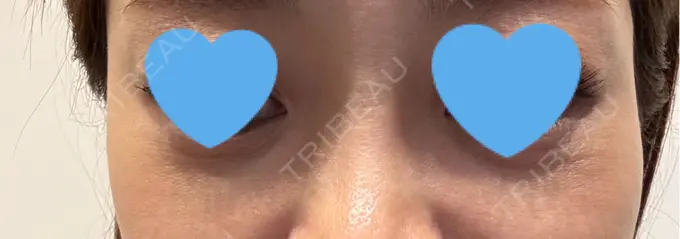 肌育注射（ジュベルックなど） GRACY TOKYO CLINIC【グレイシートウキョウクリニック】 BEFORE メイン用