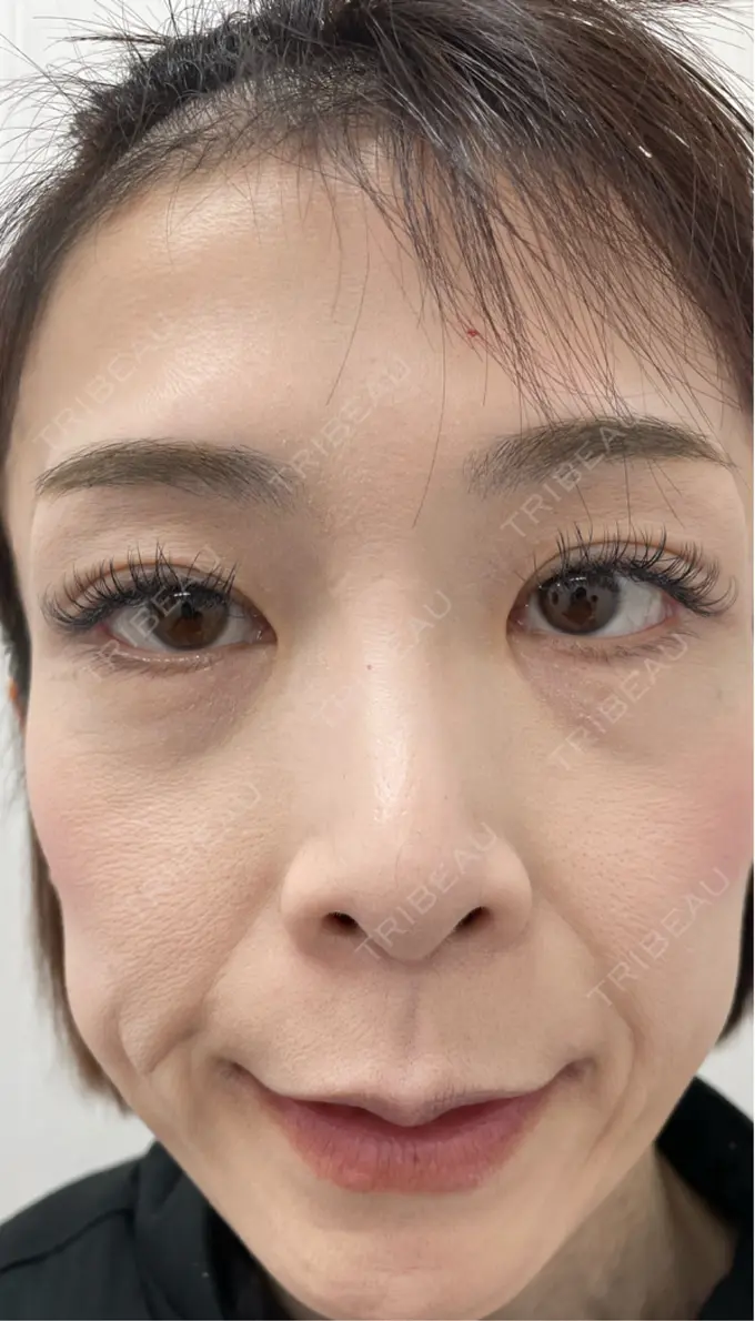 ボトックス（エラ・小顔） TCB東京中央美容外科 神戸院 BEFORE メイン用