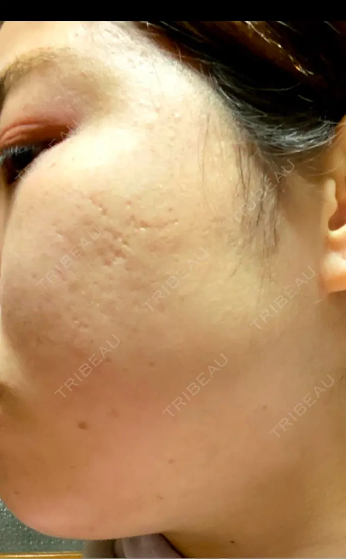 その他（肌） アーククリニック BEFORE メイン用