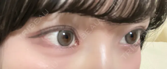 ヒアルロン酸注入（涙袋） AYANAフィラーズクリニック 渋谷院 BEFORE メイン用