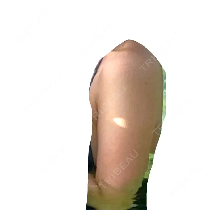 脂肪吸引（二の腕） / 脂肪吸引（肩） BBC銀座院 BEFORE メイン用