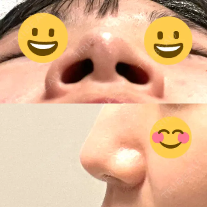 軟骨移植 R.O.clinic BEFORE メイン用