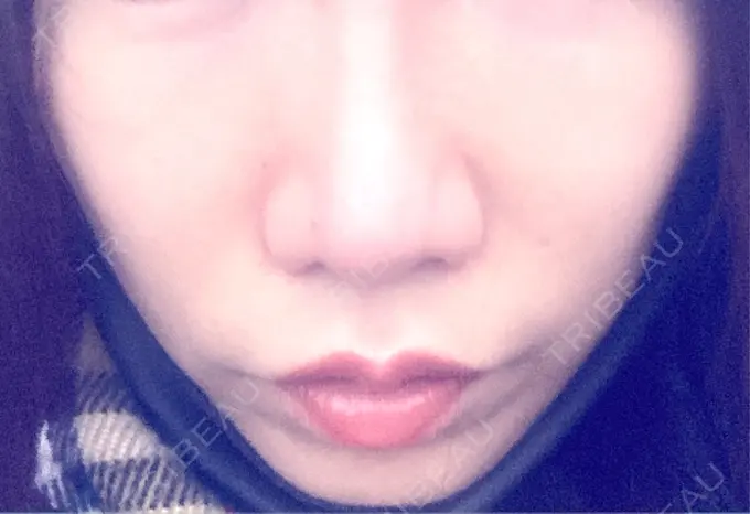 ボトックス（エラ・小顔） / ヴェルヴェットスキン おおたかの森ビューティークリニック BEFORE メイン用