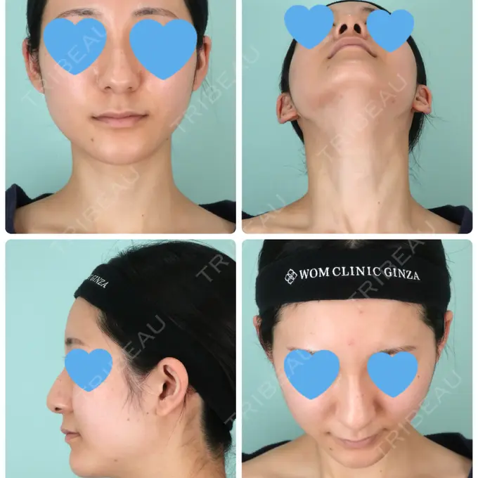 鼻尖形成（切開） / 鼻中隔延長（切開） / 軟骨移植 / 骨切幅寄せ / ワシ鼻修正・ハンプ切除 WOM CLINIC GINZA （ワム クリニック ギンザ） BEFORE メイン用