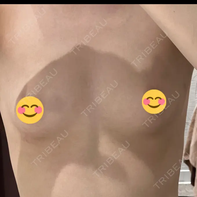 脂肪吸引（脚） / 豊胸（脂肪注入） Mods Clinic（モッズクリニック） 名古屋院 BEFORE メイン用