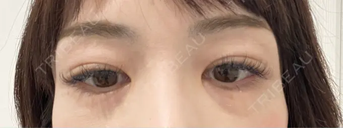 シワ取りボトックス TCB東京中央美容外科 神戸院 BEFORE メイン用