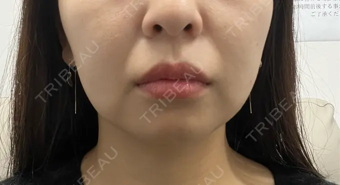 RF（高周波）たるみ治療 BISIN GINZA CLINIC BEFORE メイン用