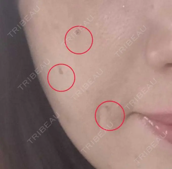 ほくろ・いぼ切除（肌） 品川美容外科 仙台院 BEFORE メイン用