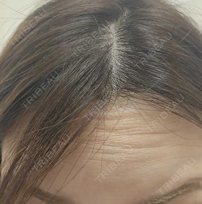 ボトックス（額） TCB東京中央美容外科 町田院 BEFORE メイン用