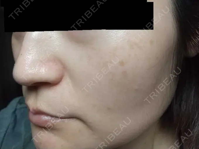 ピコスポット お茶の水美容形成クリニック BEFORE メイン用