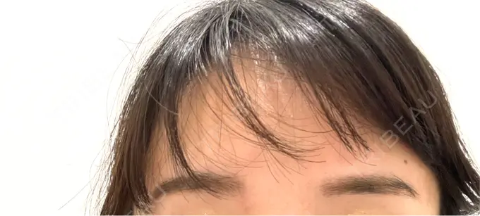 アートメイク（眉） 椿クリニック 心斎橋院 BEFORE メイン用