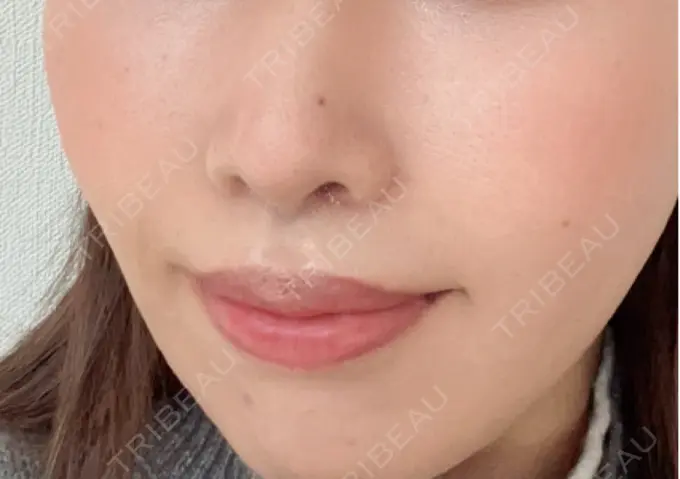 人中短縮 / 口角挙上 / その他（口元） R Beauty CLINIC 銀座院 BEFORE メイン用