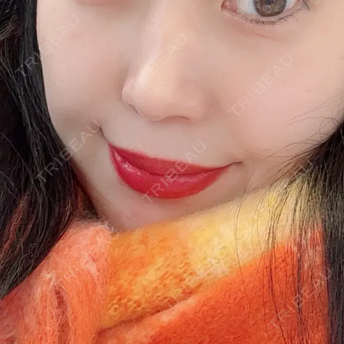 ピーリング（ニキビ・毛穴） / イオン導入 / レーザートーニング（美白・肝斑） 渋谷美容外科クリニック 渋谷院 BEFORE メイン用