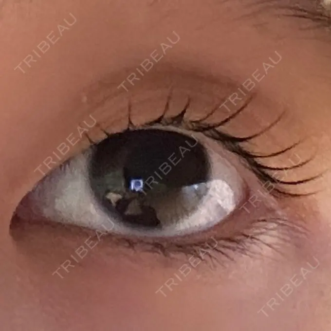 二重埋没 仙台N美容クリニック BEFORE メイン用