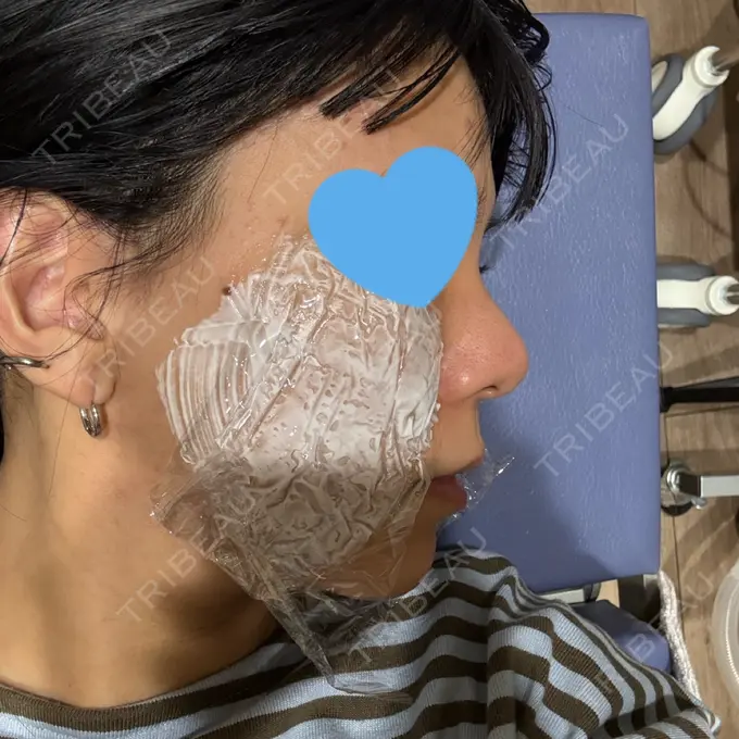 ヒアルロン酸注入（鼻） / ボトックス（エラ・小顔） / ヒアルロン酸注入（唇） / 美容点滴・美容注射（美肌） / ヒアルロン酸注入（鼻翼基部） HAAB BEAUTY CLINIC 名古屋院 BEFORE メイン用