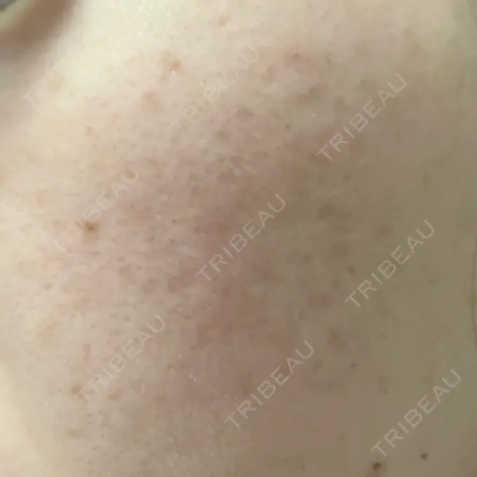 サブシジョン / 肌育注射（ジュベルックなど） / その他（肌） ゆきスキンクリニック 東池袋 BEFORE メイン用