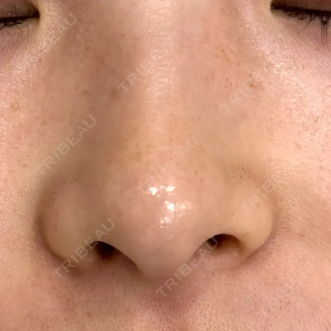 毛穴洗浄（ハイドラフェイシャルなど） BAO CLINIC 梅田院 BEFORE メイン用