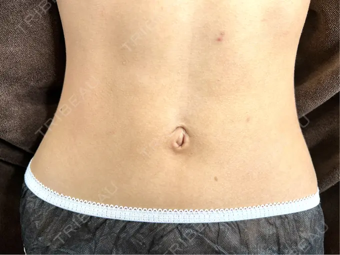 へそ形成 藤・ナチュレ美容クリニック 銀座院 BEFORE メイン用