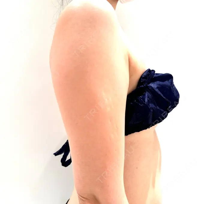 脂肪吸引（二の腕） / 脂肪吸引（脚） / 豊胸（脂肪注入） Mods Clinic（モッズクリニック） 名古屋院 BEFORE メイン用