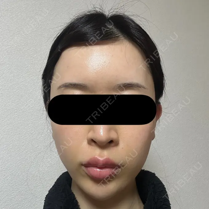 糸リフト / バッカルファット除去 / 脂肪吸引（顔） / ジョールファット除去 / ヒアルロン酸注入（額） / ヒアルロン酸注入（頬） BLINC CLINIC （ブリンク クリニック） BEFORE メイン用