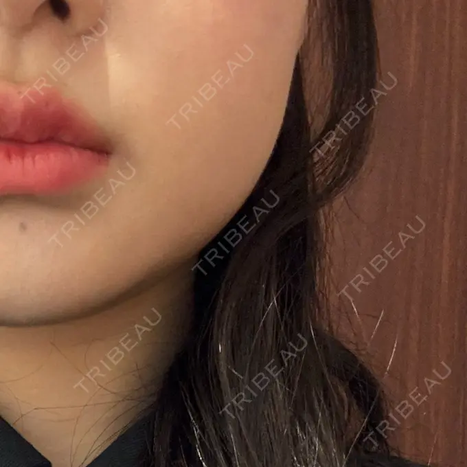 脂肪溶解注射（顔） SK新宿歌舞伎町美容外科・歯科 BEFORE メイン用