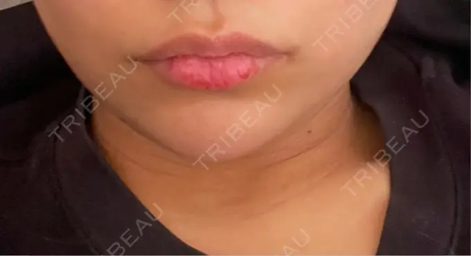 ボトックス（エラ・小顔） L‘amour clinic Tokyo【ラムールクリニック東京】 BEFORE メイン用