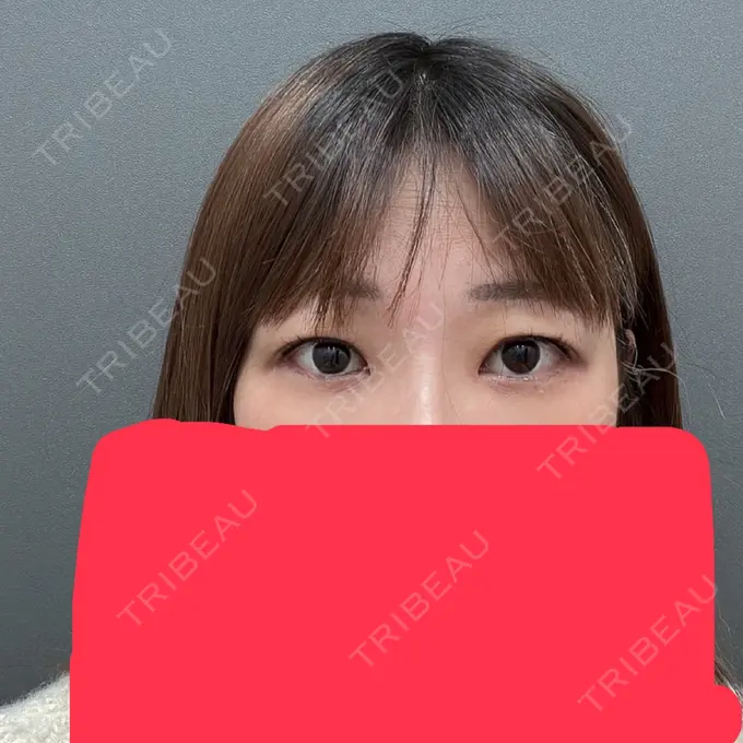 二重埋没 ネビュラクリニック 広島院 BEFORE メイン用