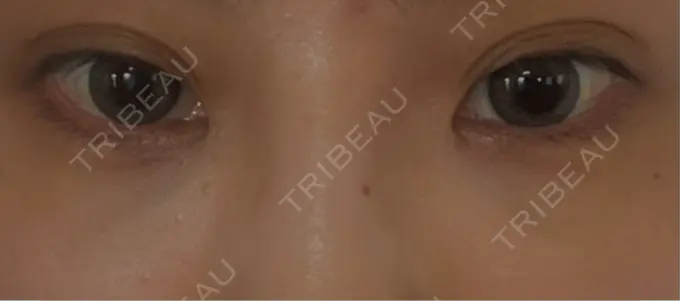 ヒアルロン酸溶解 麻布十番クレールデンタルクリニック BEFORE メイン用