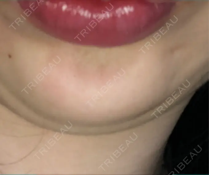 ボトックス（あご） / ボトックス（眉間） 湘南美容クリニック 博多院 BEFORE メイン用