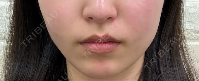 ボトックス（エラ・小顔） 共立美容外科 千葉院 BEFORE メイン用