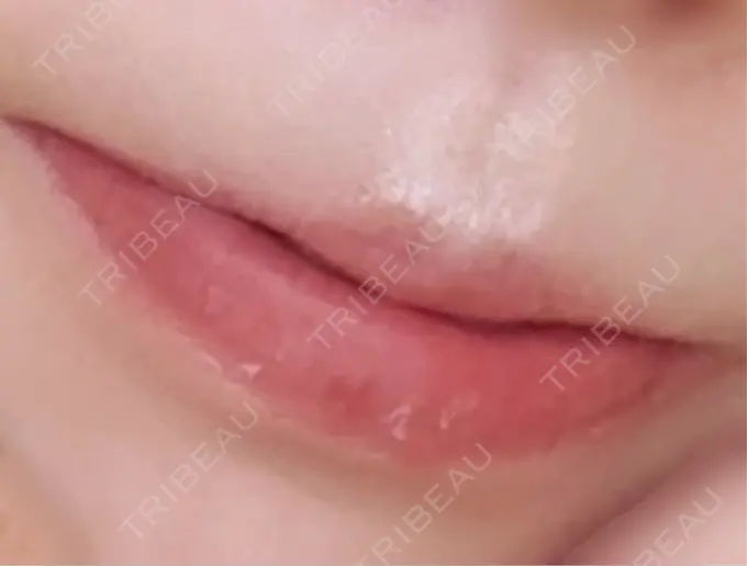 口角挙上 / その他（口元） R Beauty CLINIC 銀座院 BEFORE メイン用