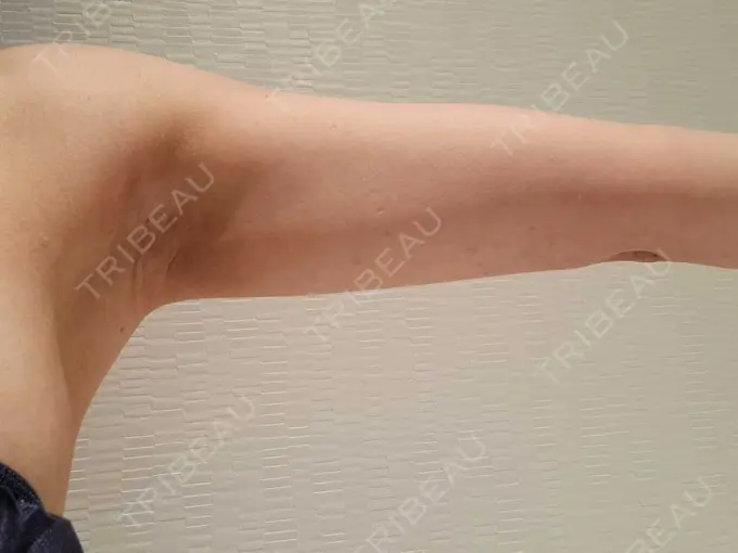 クマ治療 / 脂肪吸引（顔） / 脂肪吸引（二の腕） / 脂肪吸引（肩） / 脂肪注入（目の下） Mods Clinic（モッズクリニック） 名古屋院 BEFORE メイン用