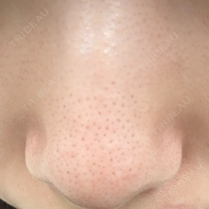 アグネス 日本美容・医療クリニック 六本木院 BEFORE メイン用