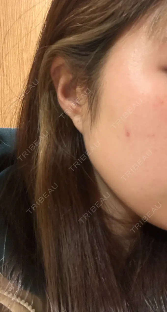 ピーリング（ニキビ・毛穴） おおたかの森ビューティークリニック BEFORE メイン用